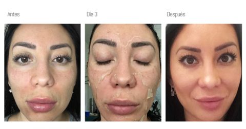 Peeling Medico Novapiel Medical Spa