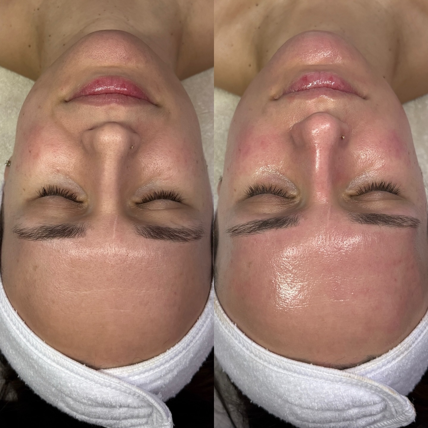 HydraFacial