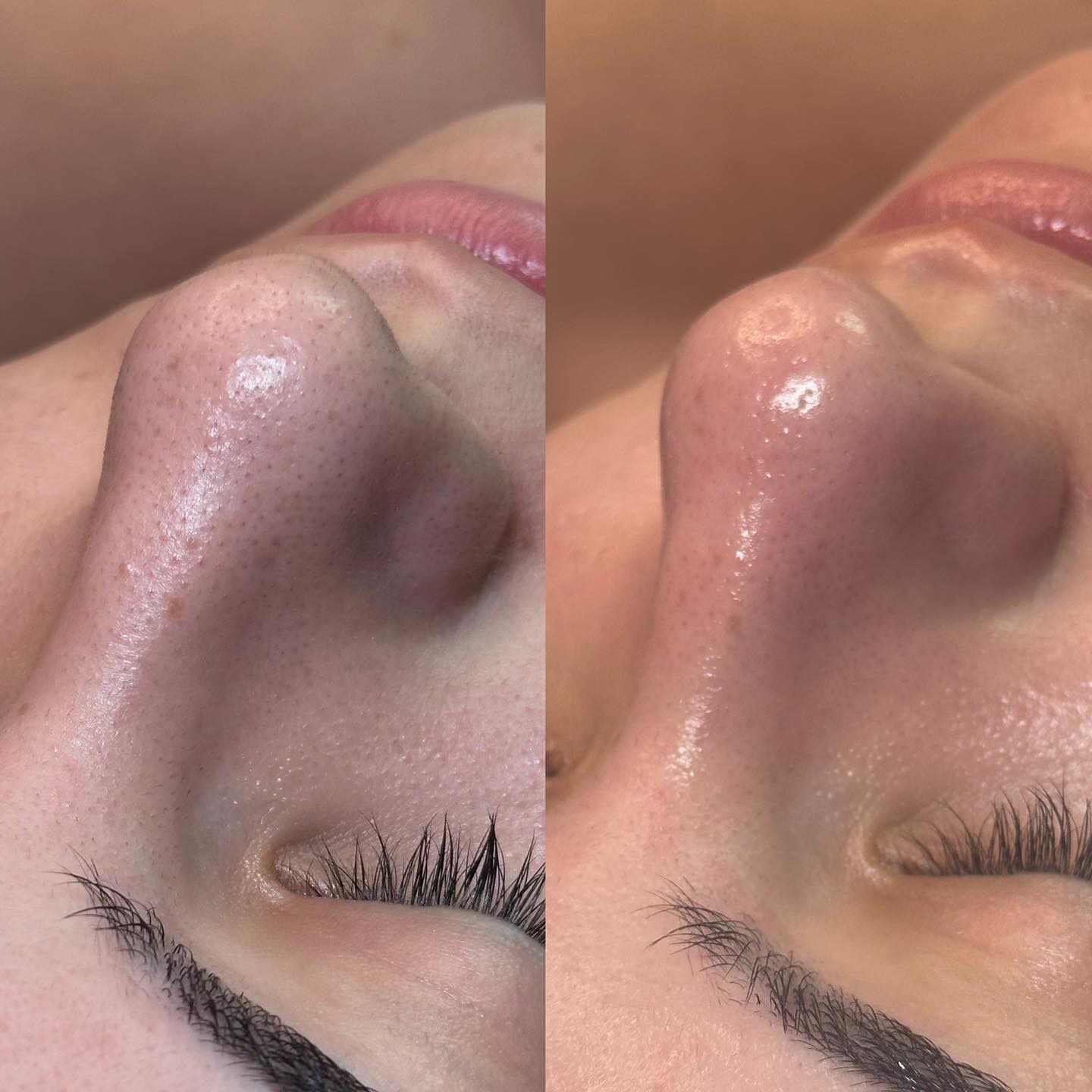 HydraFacial