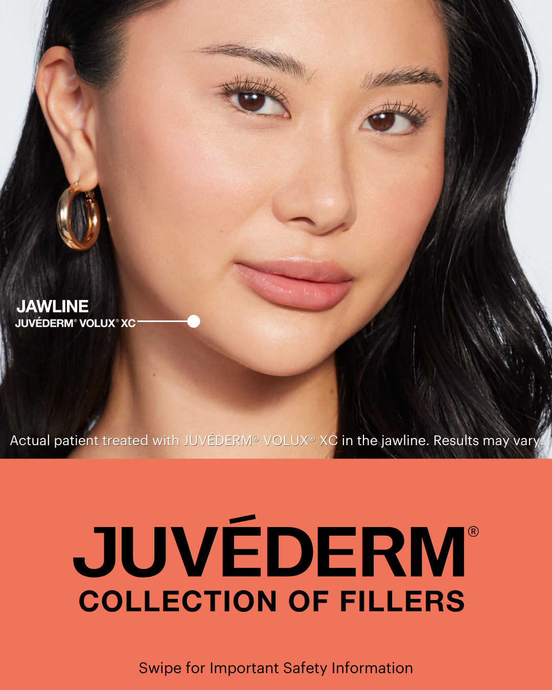 Relleno Juvederm Jawline